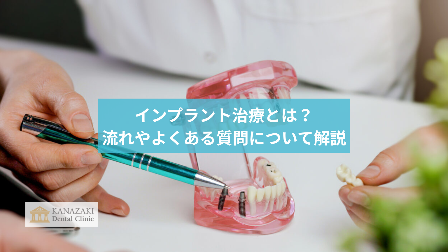 インプラント治療とは?流れやよくある質問について解説のアイキャッチ